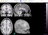 MRIcro viewing a T1 scan